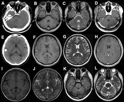 Clinical, Radiological, Pathological Features and Seizure Outcome With Surgical Management of Polymorphous Low-Grade Neuroepithelial Tumor of the Young Associated With Epilepsy